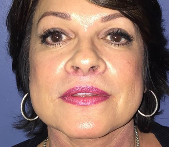 After Lip Lift Rancho Mirage