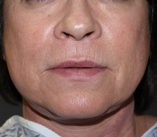 Before Lip Lift Rancho Mirage 