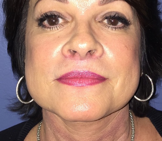 After Lip Lift Rancho Mirage