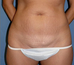 Abdominoplasty Before & After Image