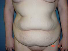 Abdominoplasty Before & After Image