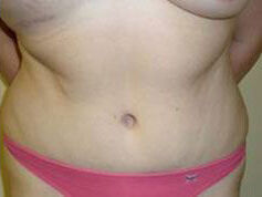 Abdominoplasty Before & After Image