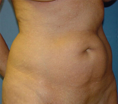 Abdominoplasty Before & After Image