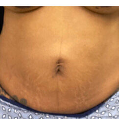 Abdominoplasty Before & After Image