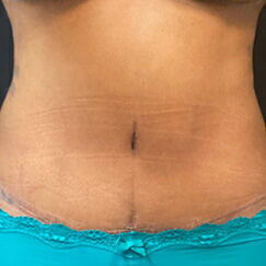 Abdominoplasty Before & After Image