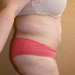 Abdominoplasty Before & After Image