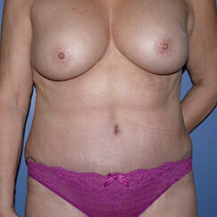 Abdominoplasty Before & After Image