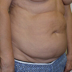 Abdominoplasty Before & After Image