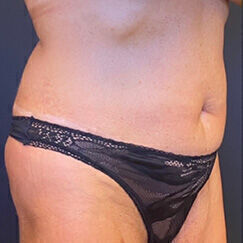 Abdominoplasty Before & After Image