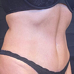 Abdominoplasty Before & After Image