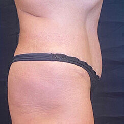 Abdominoplasty Before & After Image