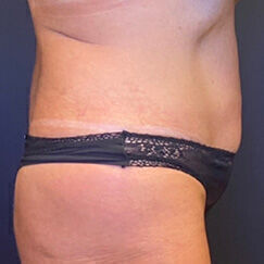 Abdominoplasty Before & After Image