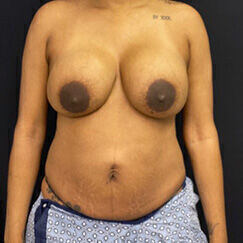 Abdominoplasty Before & After Image