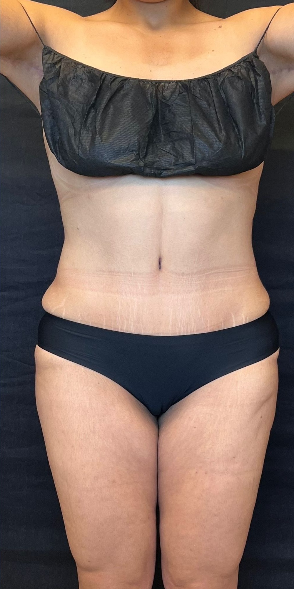 Abdominoplasty Before & After Image