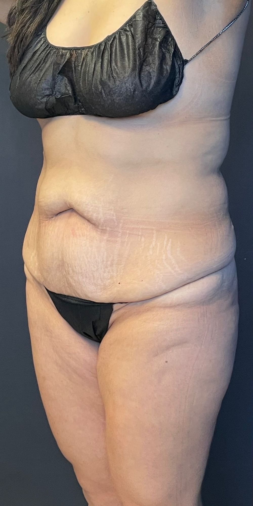 Abdominoplasty Before & After Image