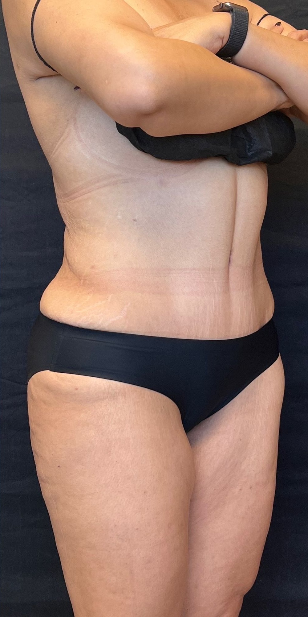 Abdominoplasty Before & After Image