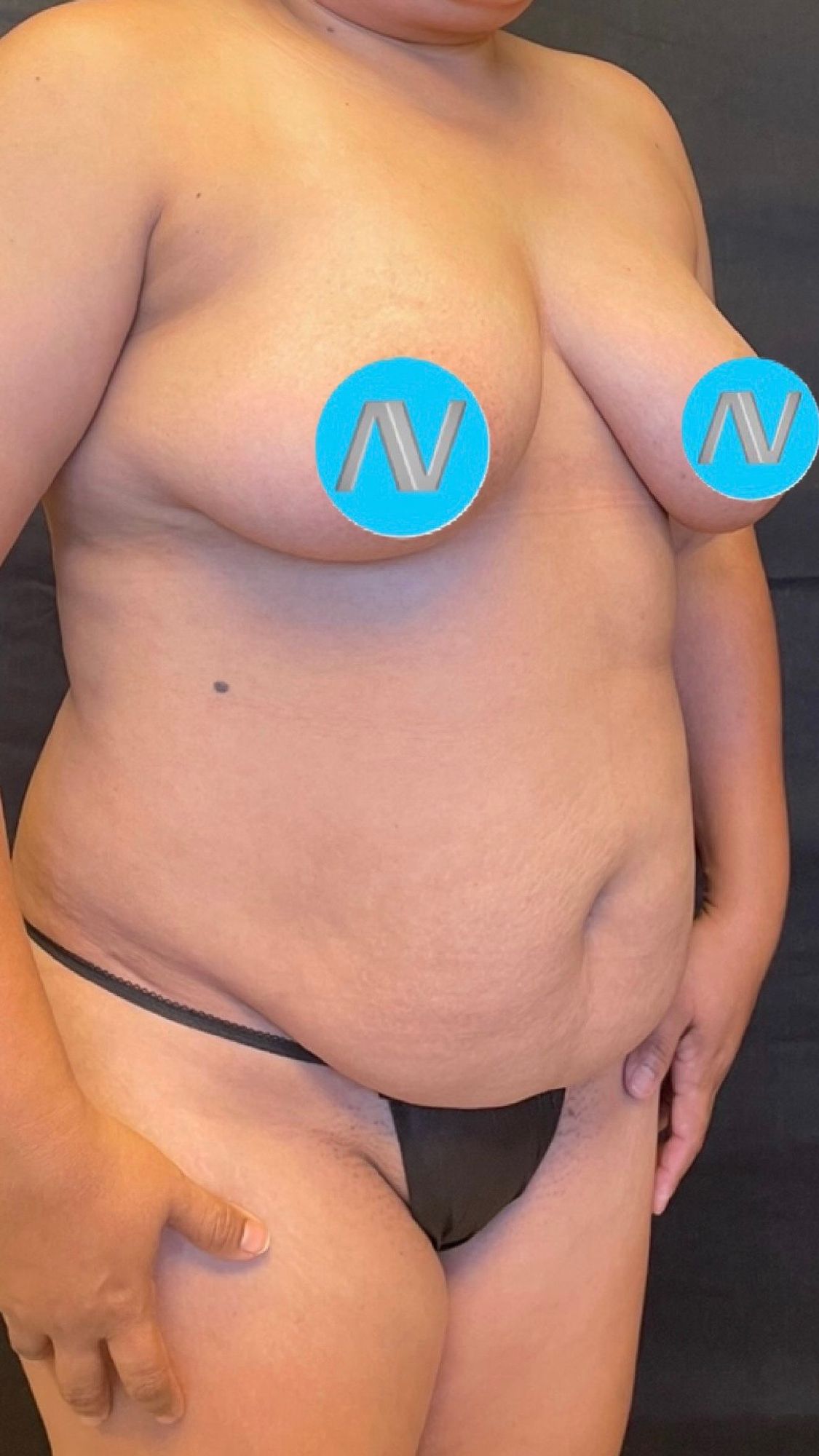 Abdominoplasty Before & After Image