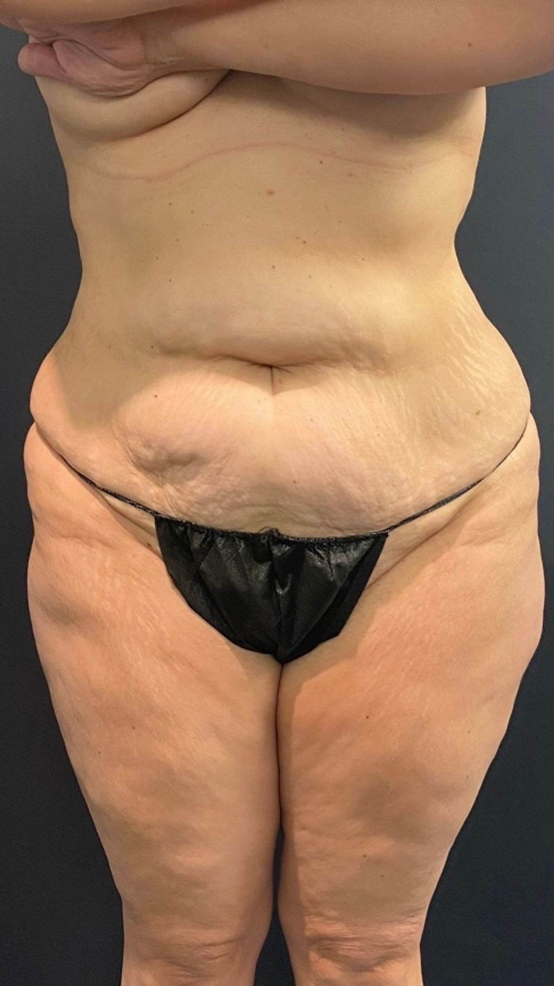 Abdominoplasty Before & After Image