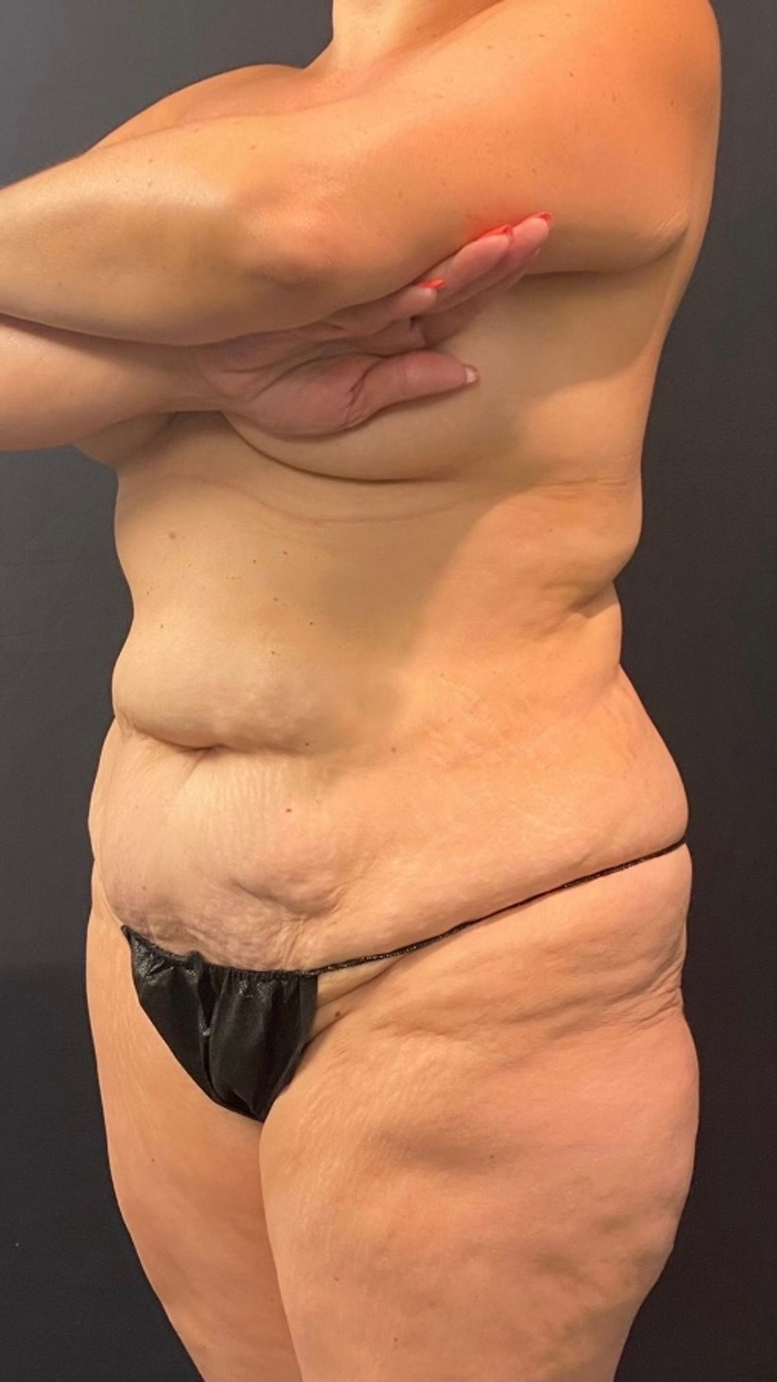 Abdominoplasty Before & After Image