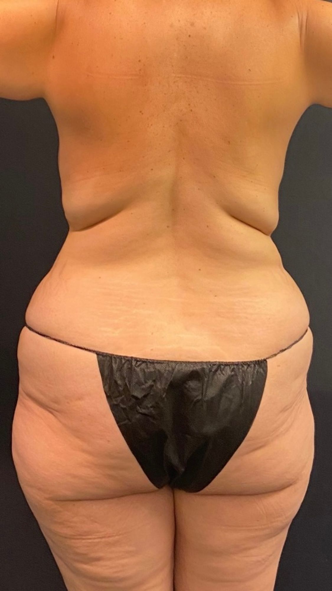 Abdominoplasty Before & After Image