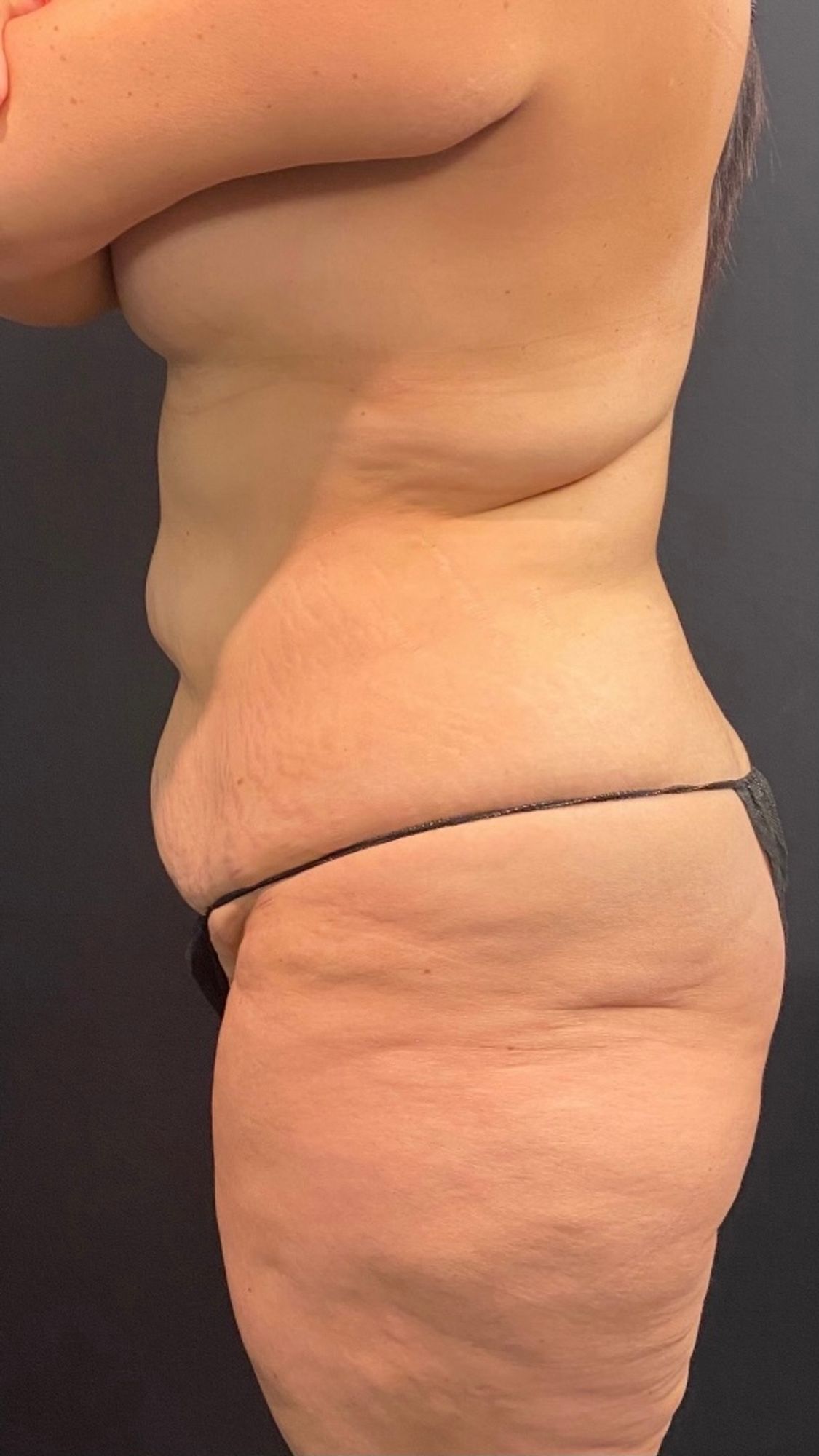 Abdominoplasty Before & After Image