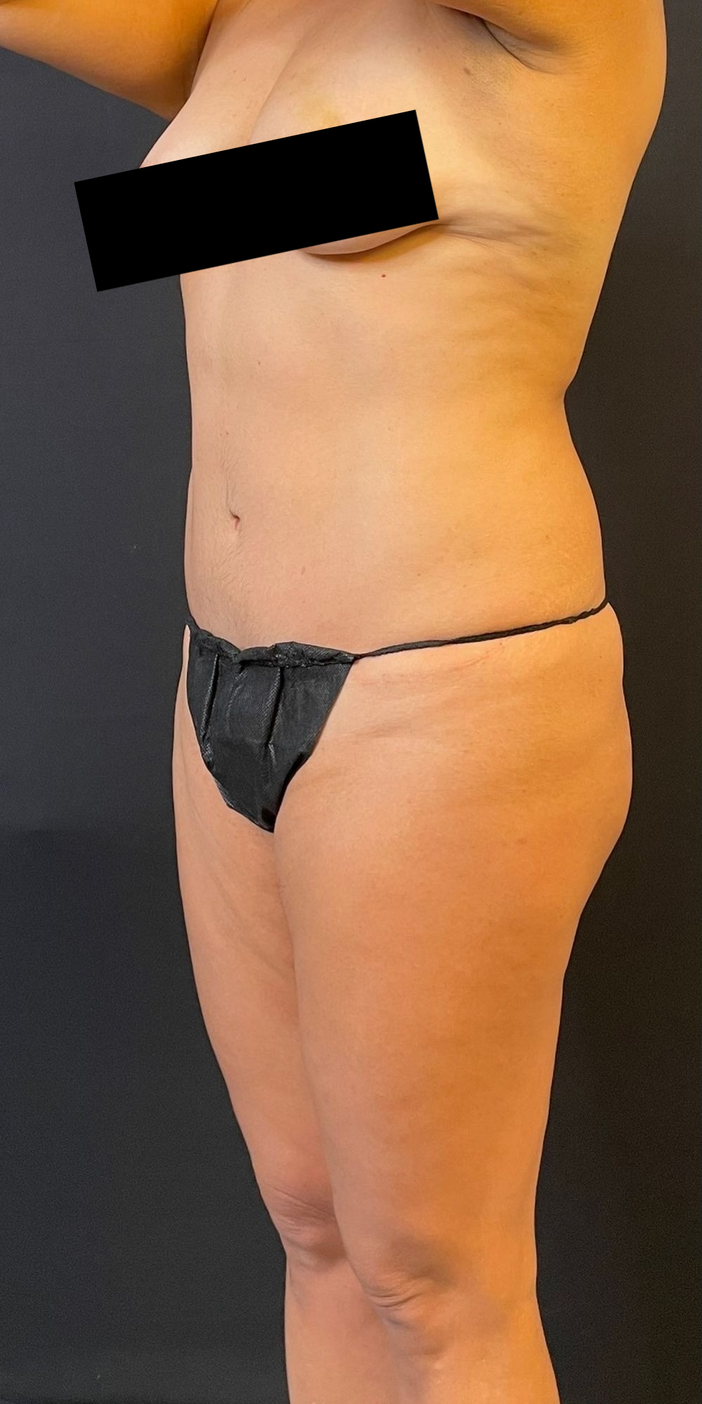 Brazilian Butt Lift Before & After Image