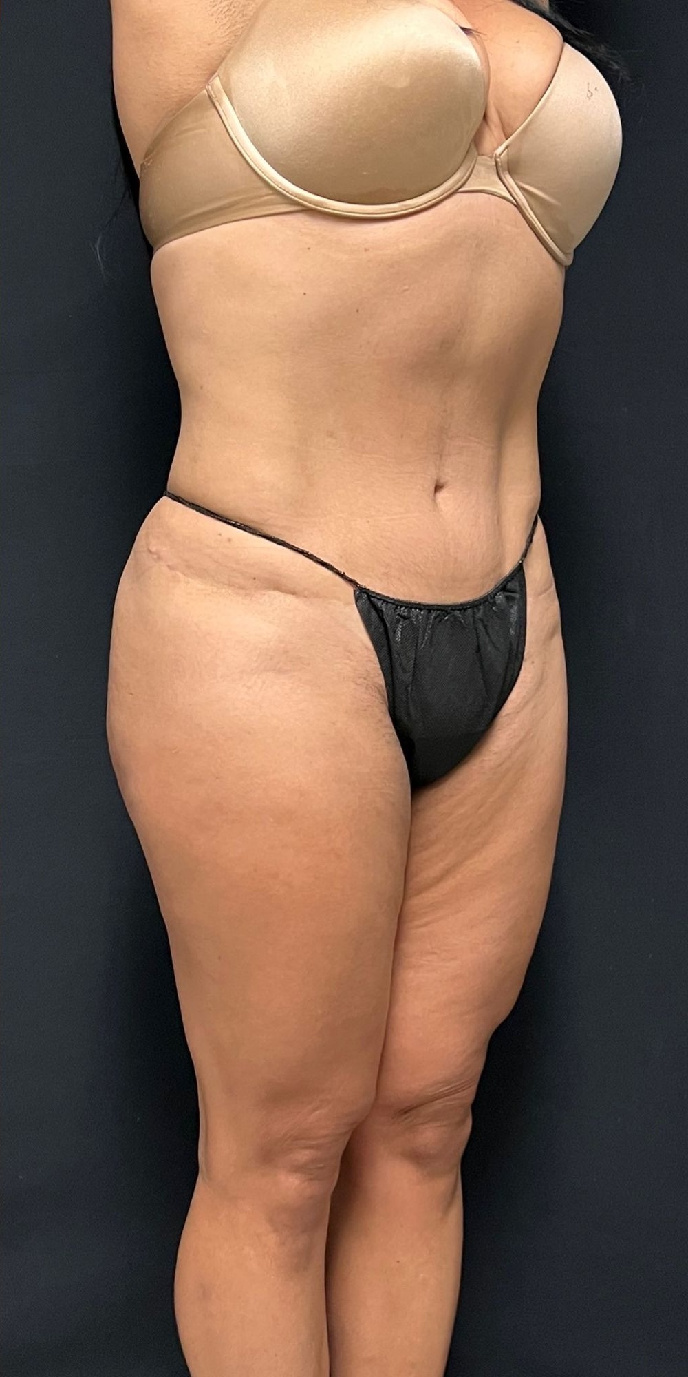 Brazilian Butt Lift Before & After Image