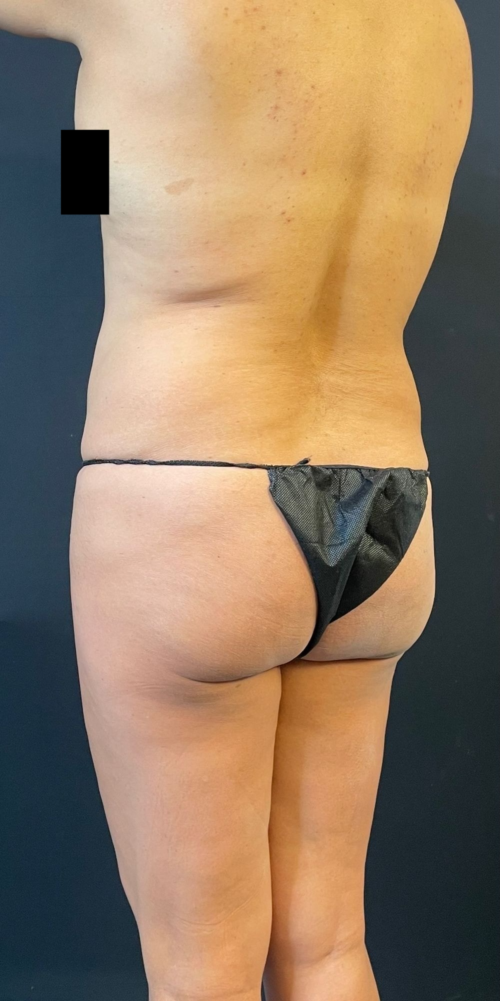 Brazilian Butt Lift Before & After Image