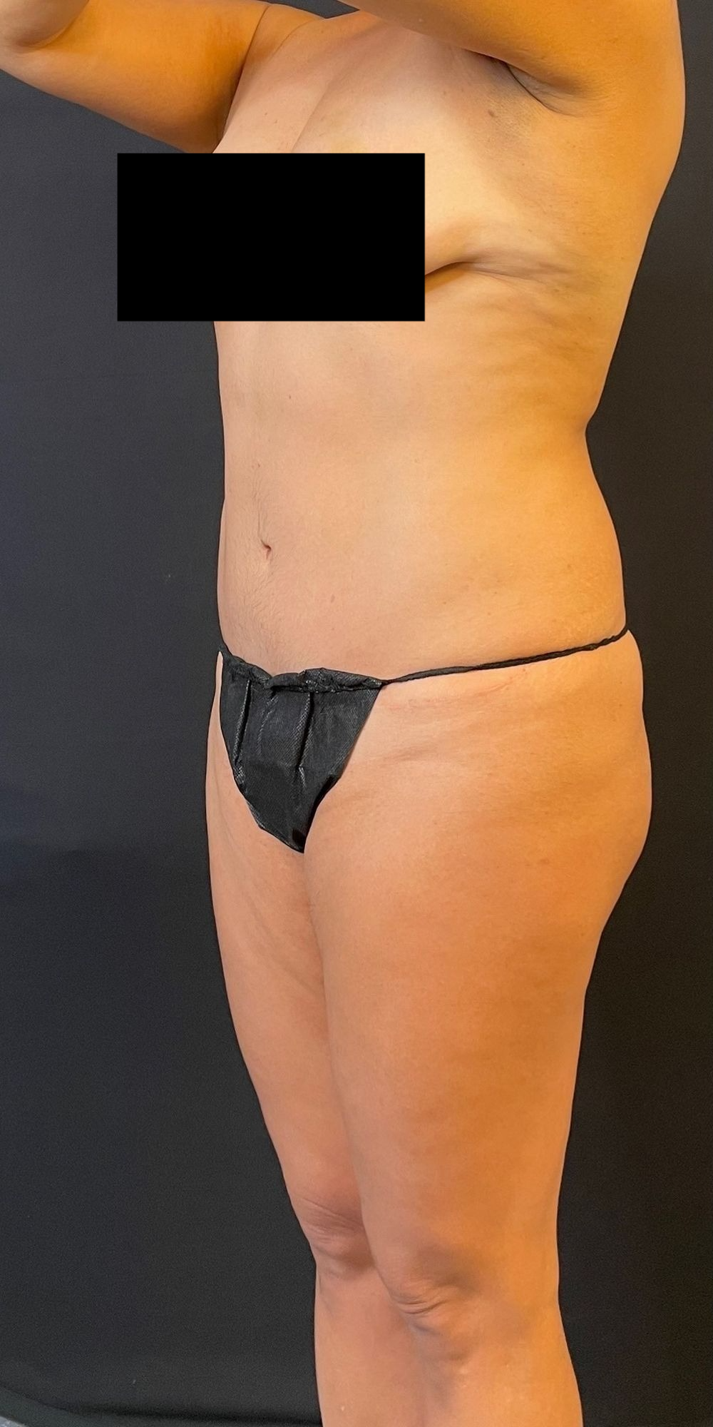 Brazilian Butt Lift Before & After Image