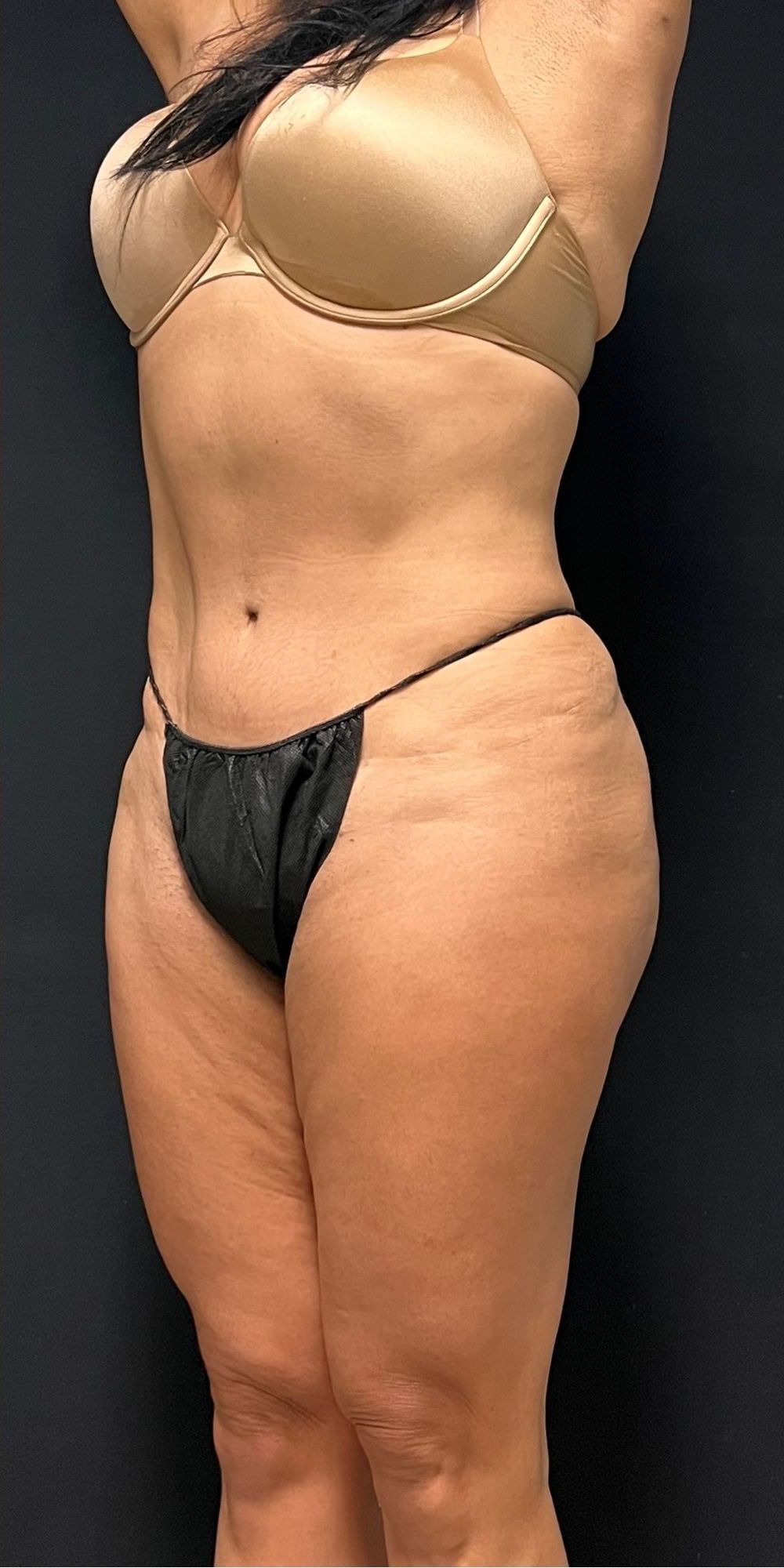 Brazilian Butt Lift Before & After Image