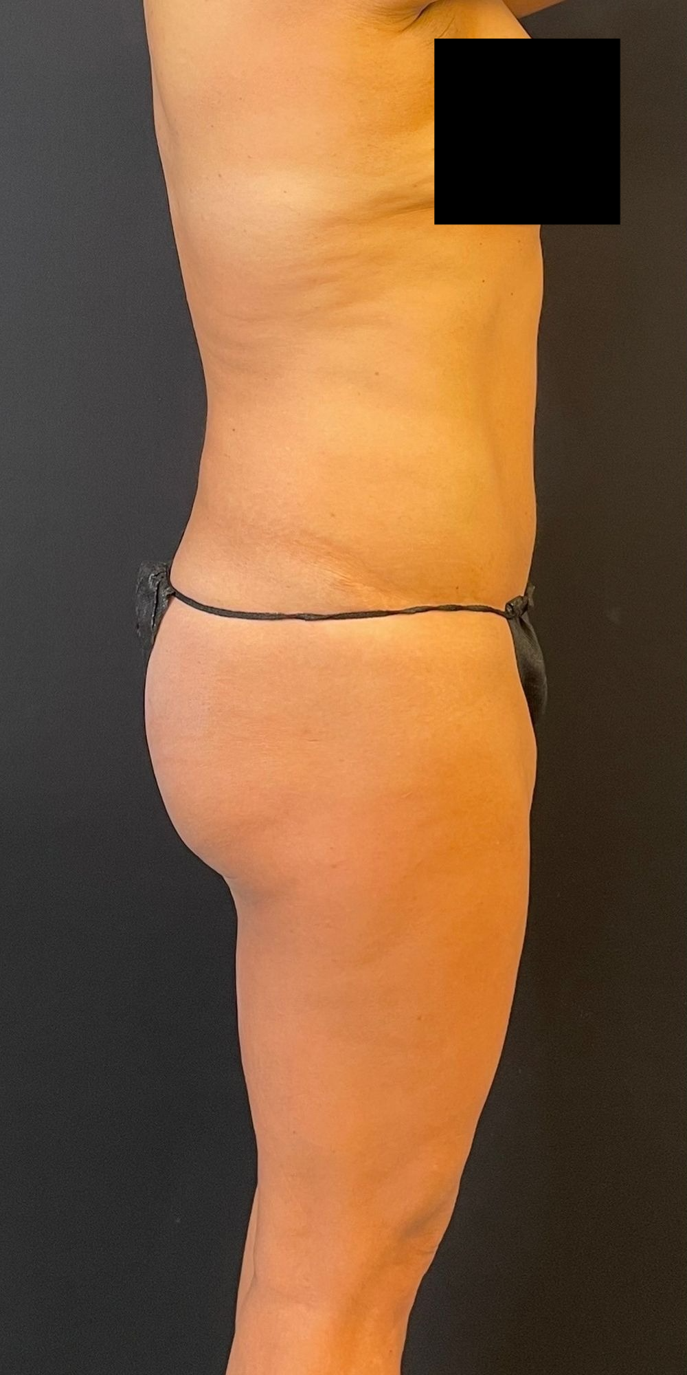 Brazilian Butt Lift Before & After Image