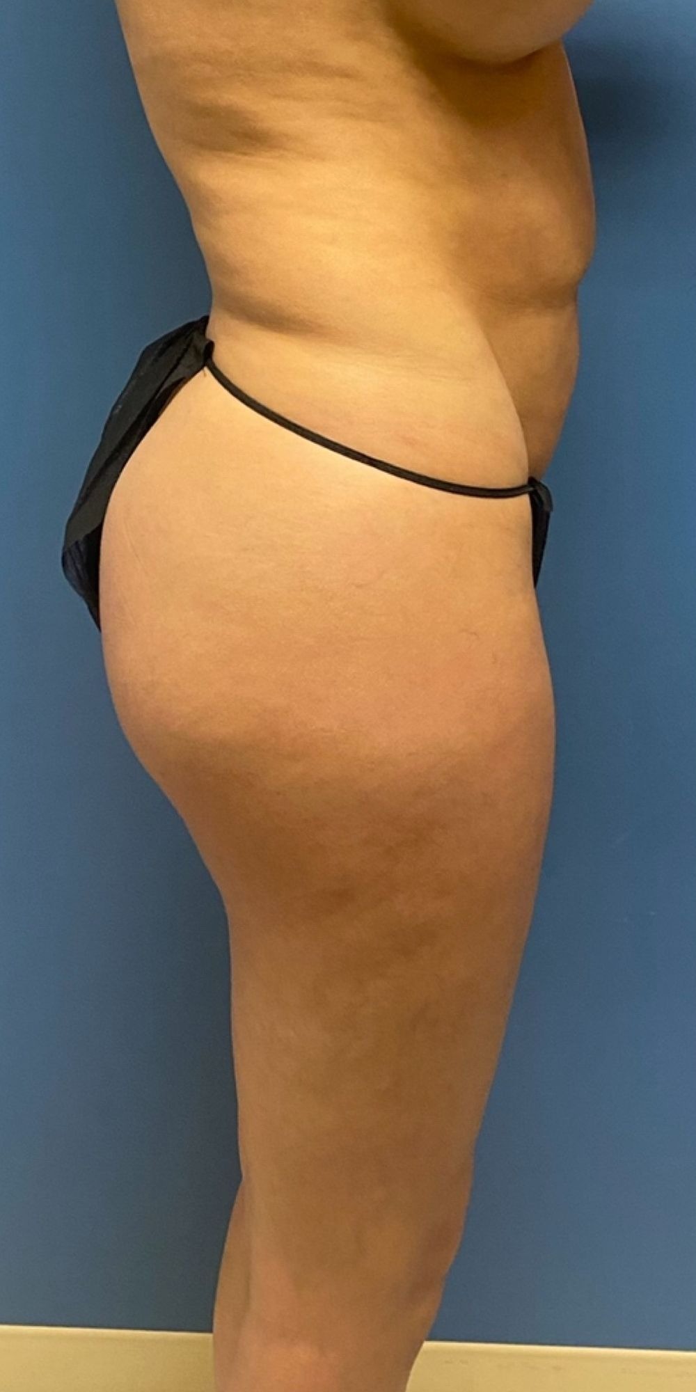 Brazilian Butt Lift Before & After Image