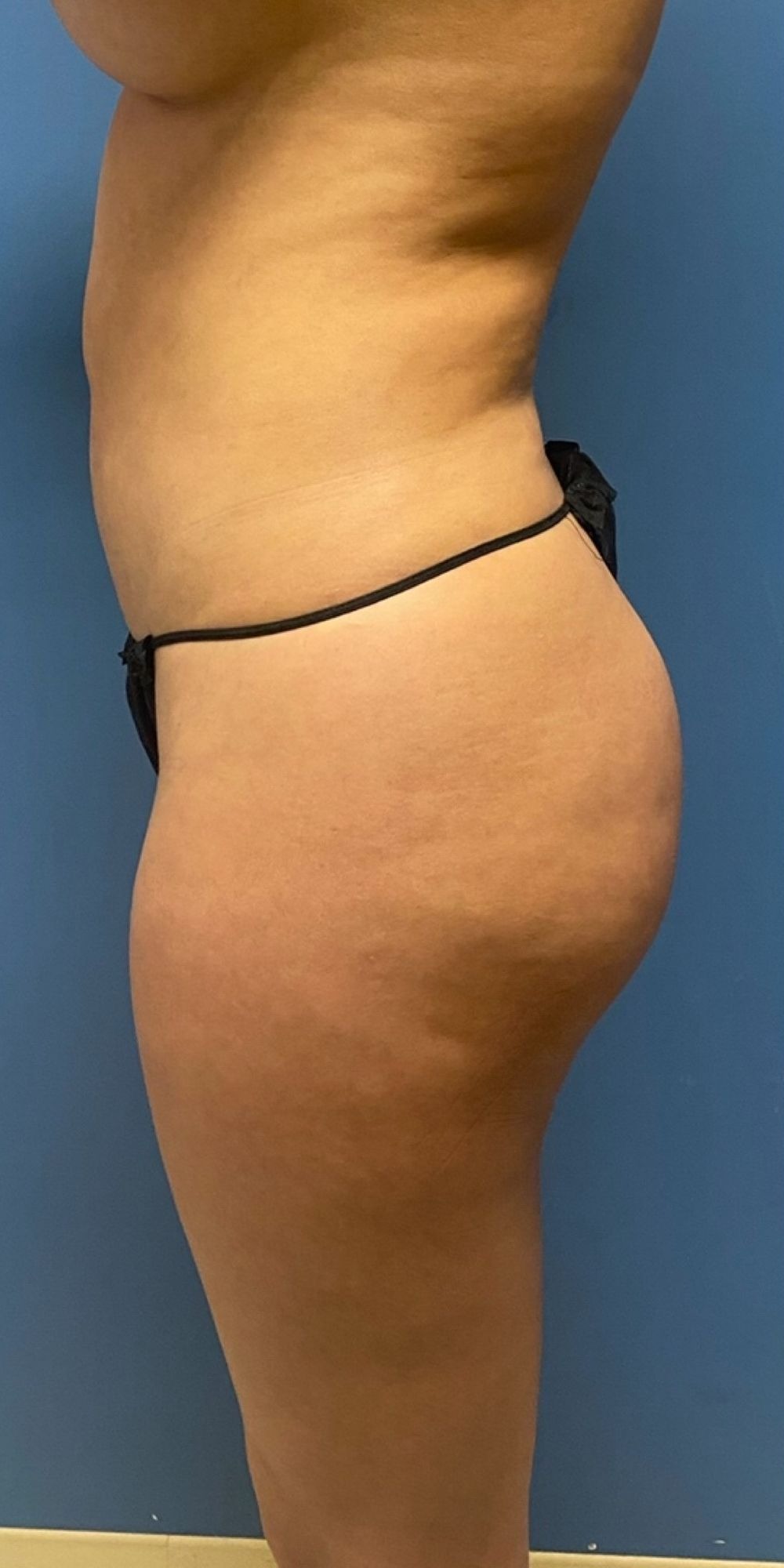 Brazilian Butt Lift Before & After Image