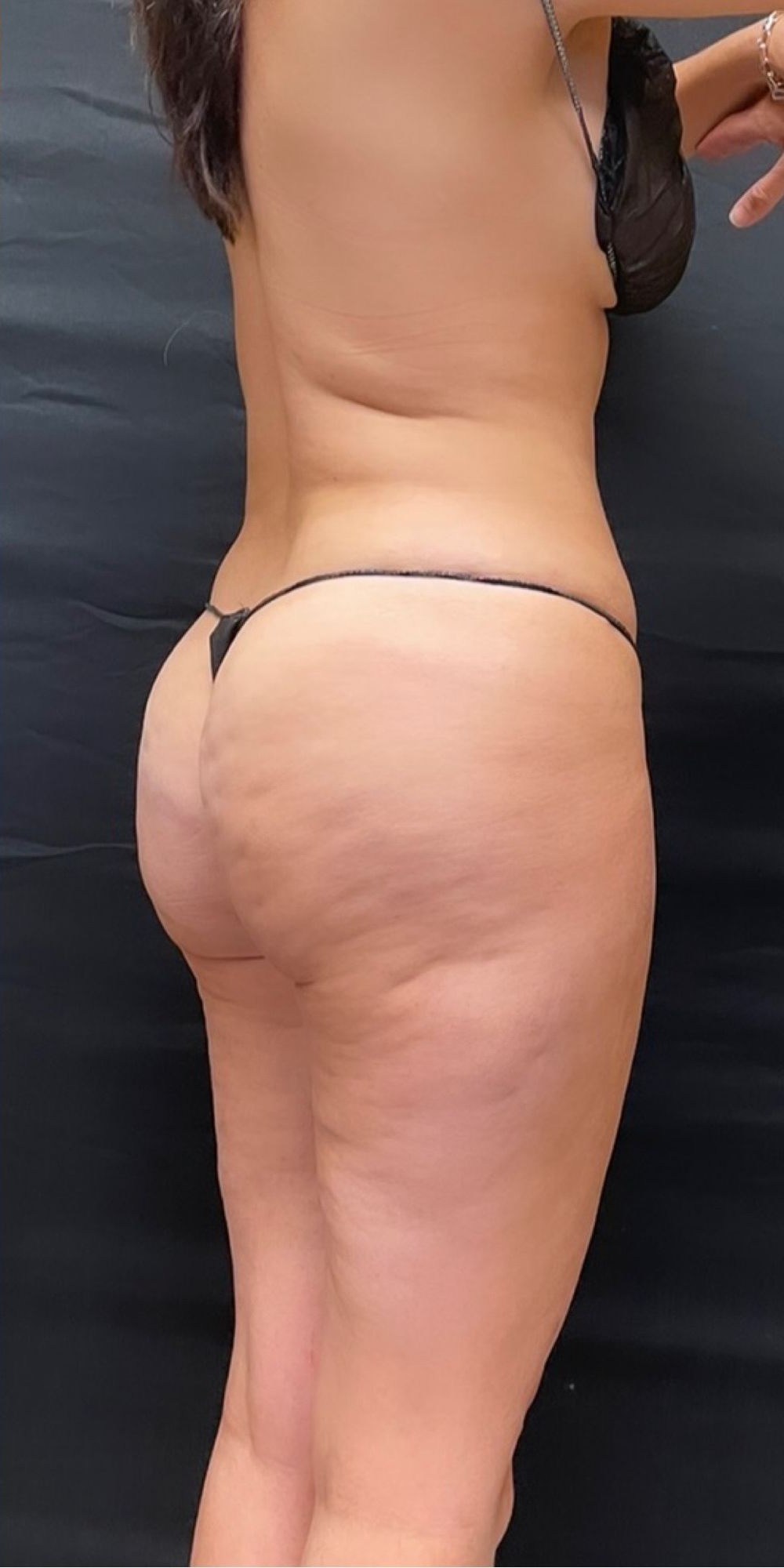 Brazilian Butt Lift Before & After Image