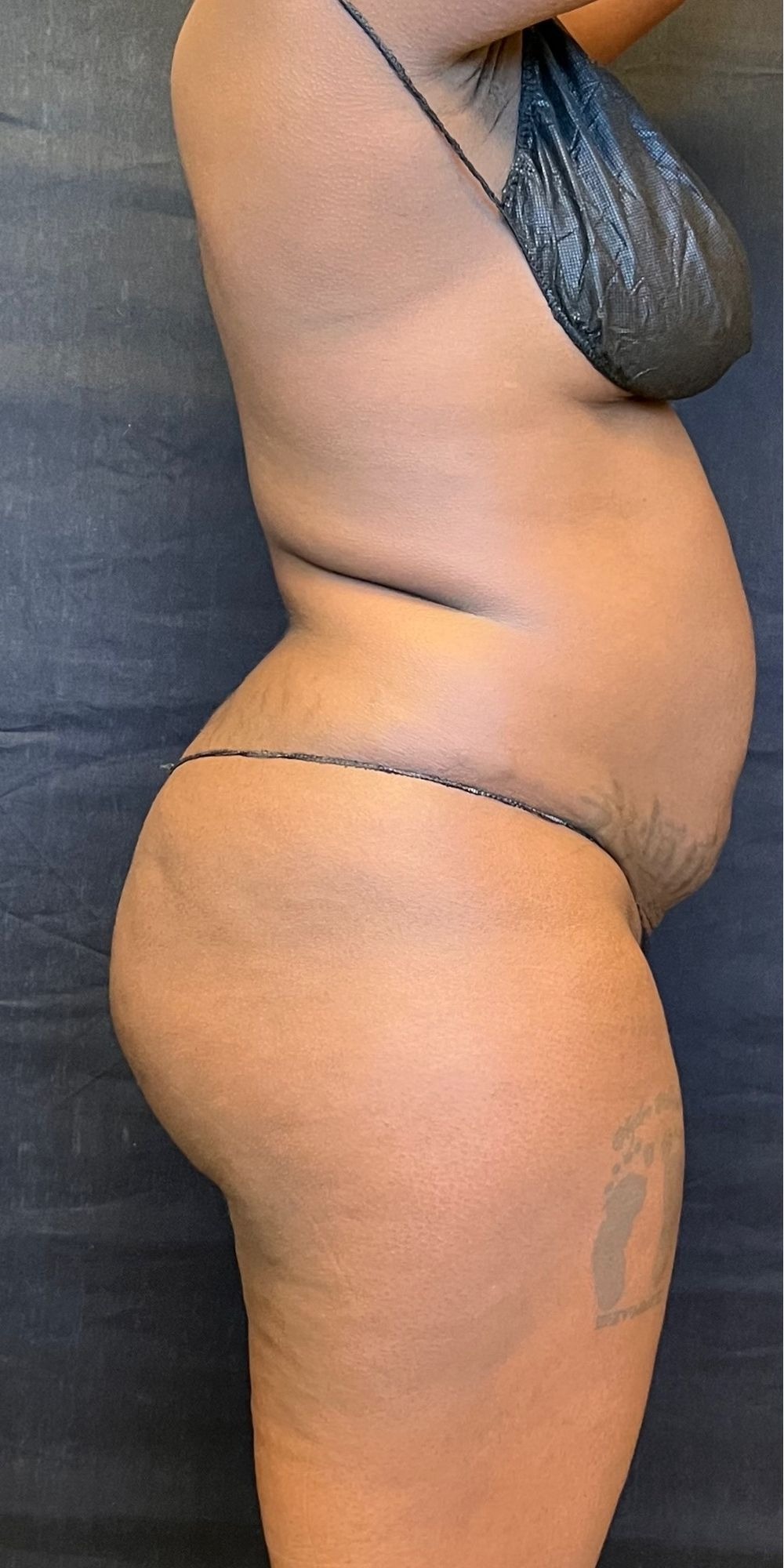 Brazilian Butt Lift Before & After Image