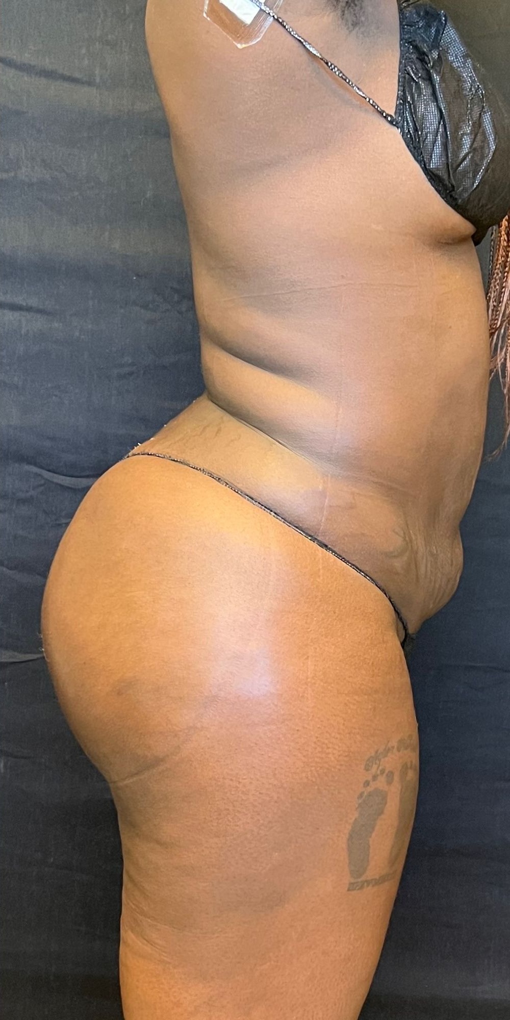 Brazilian Butt Lift Before & After Image