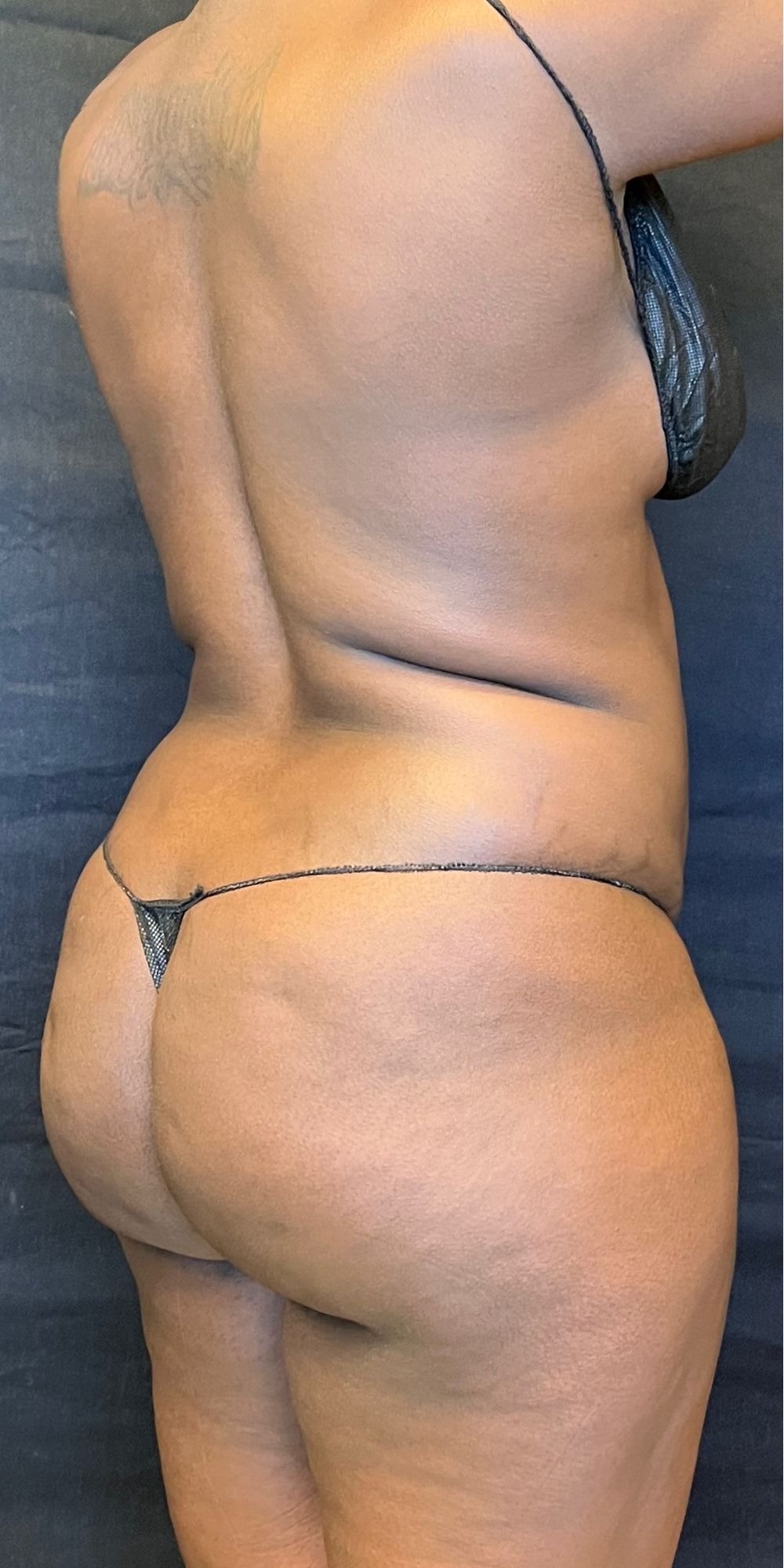 Brazilian Butt Lift Before & After Image