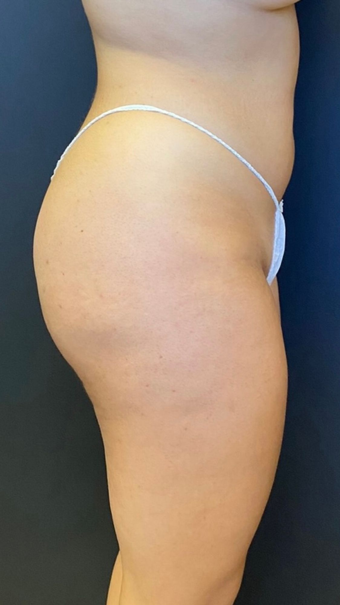 Brazilian Butt Lift Before & After Image