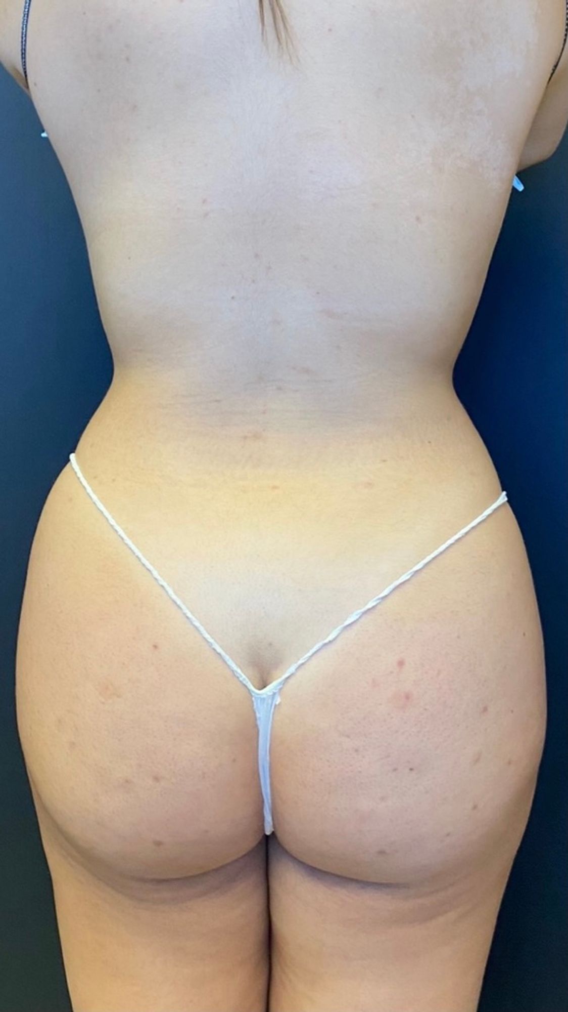 Brazilian Butt Lift Before & After Image