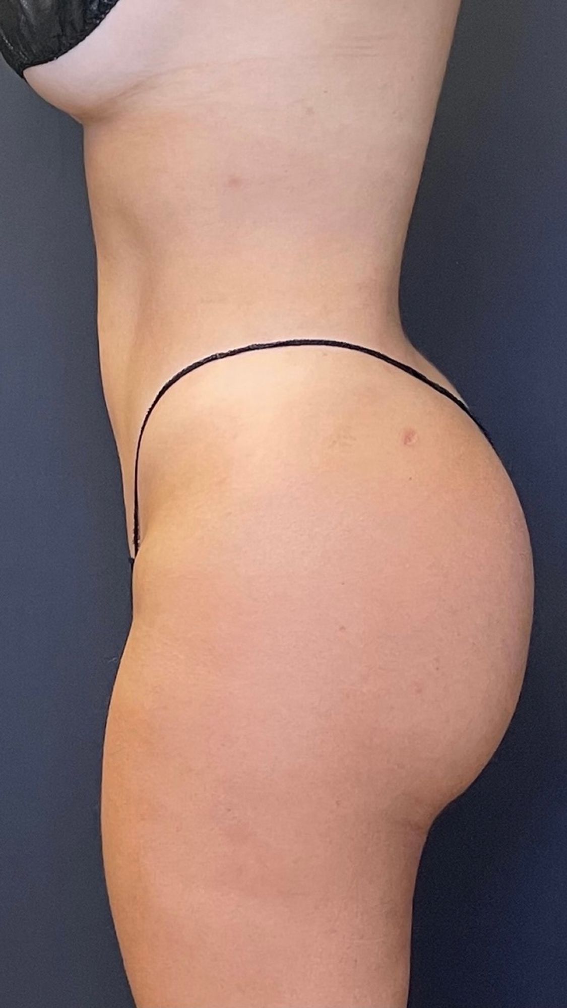 Brazilian Butt Lift Before & After Image