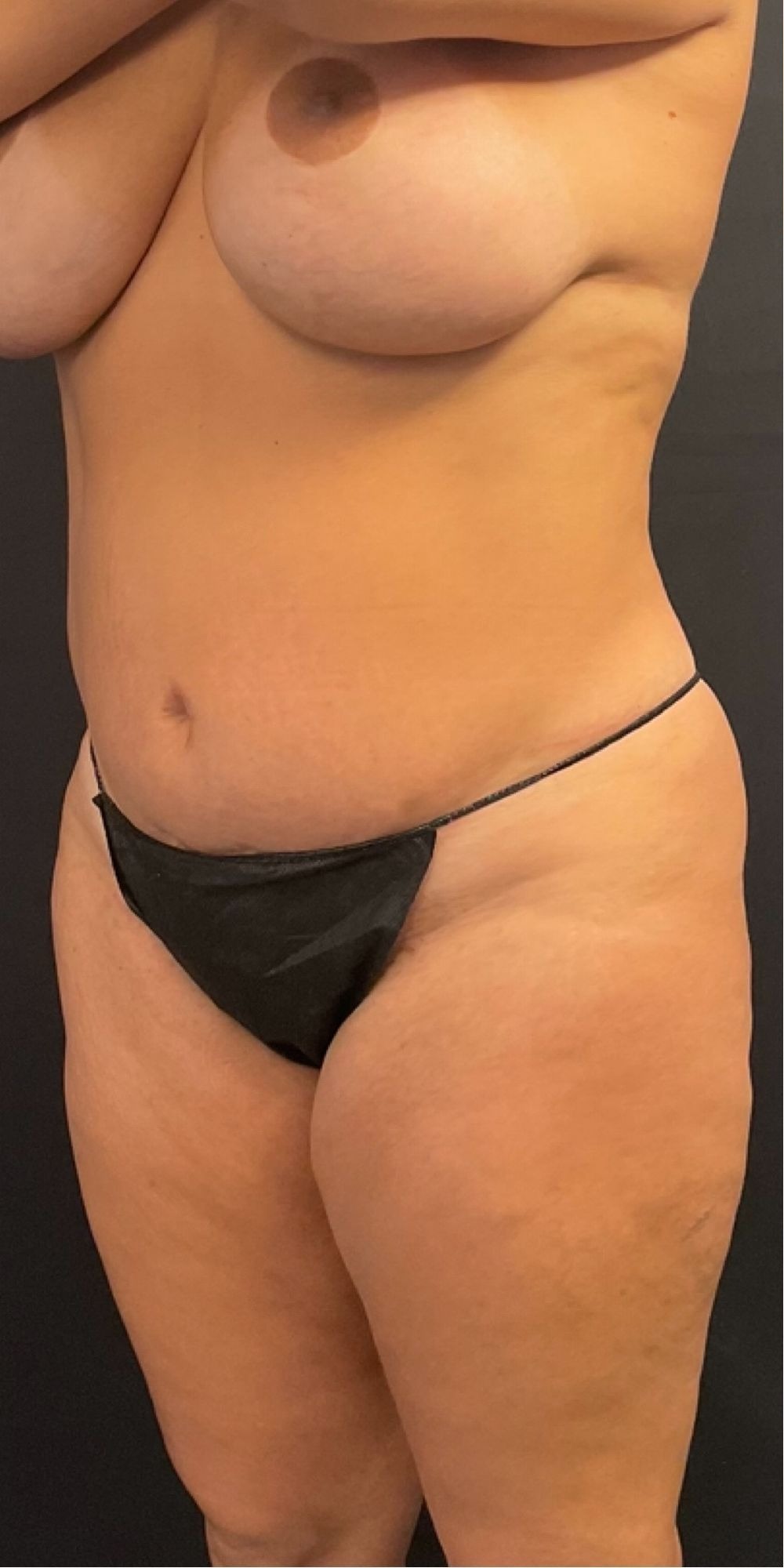 Brazilian Butt Lift Before & After Image