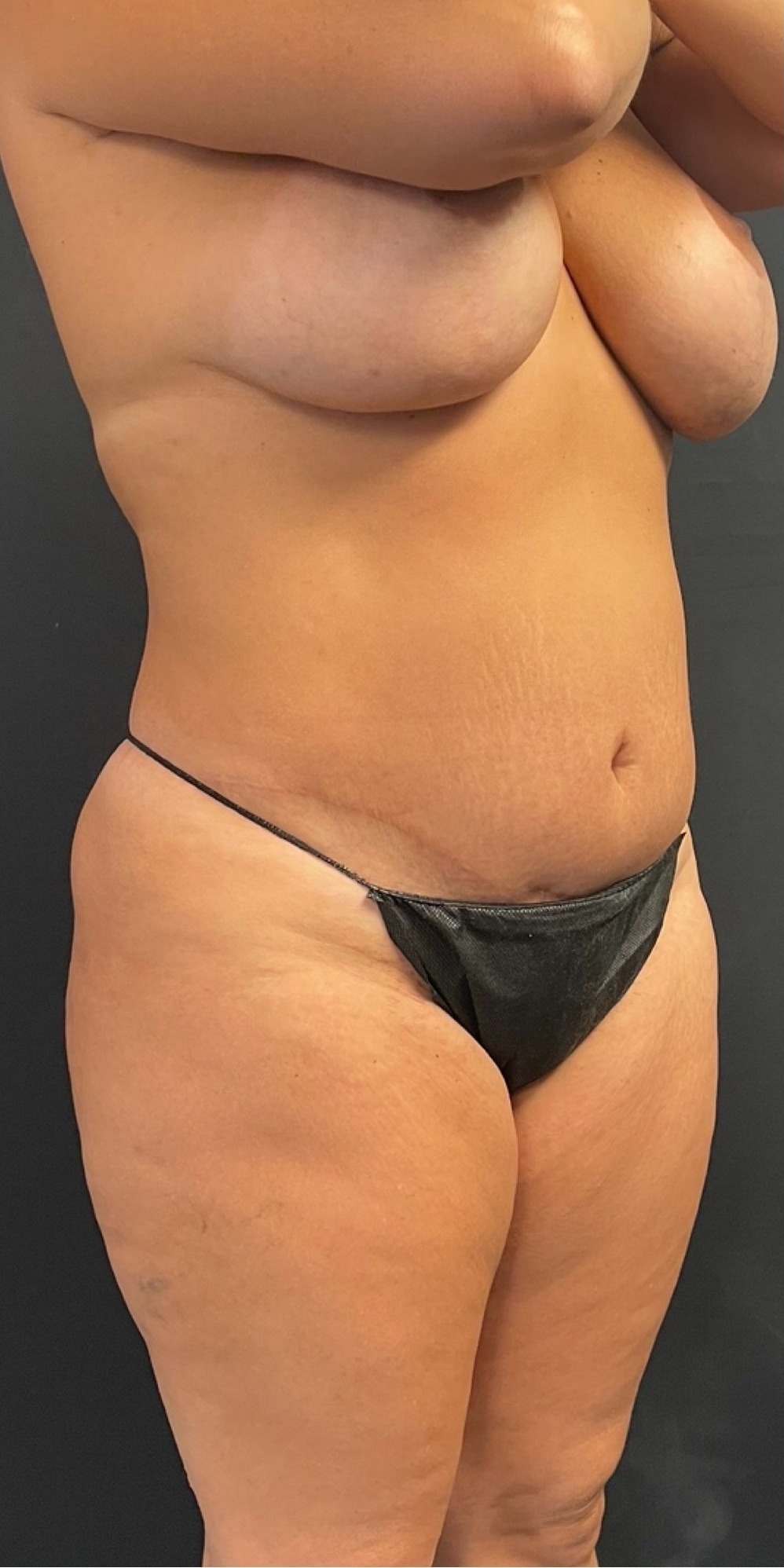 Brazilian Butt Lift Before & After Image