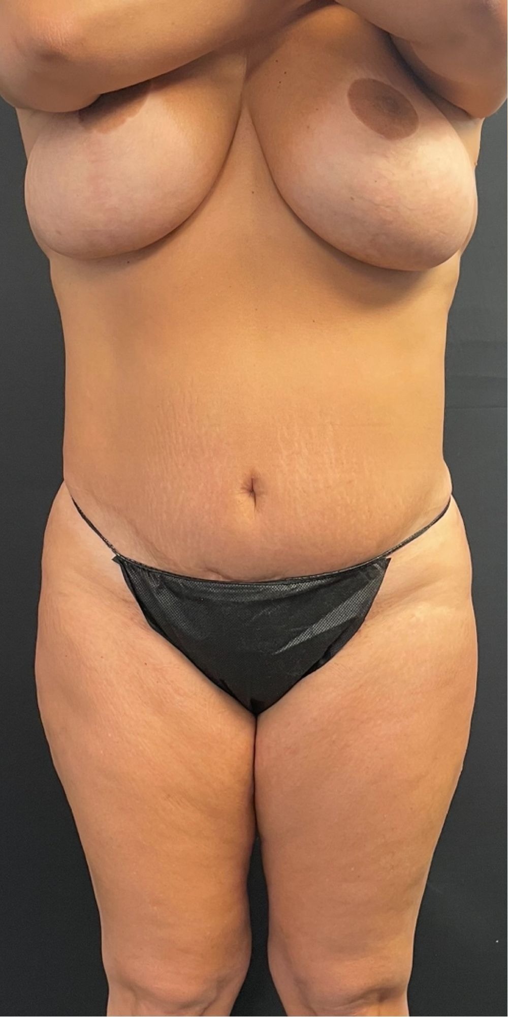 Brazilian Butt Lift Before & After Image