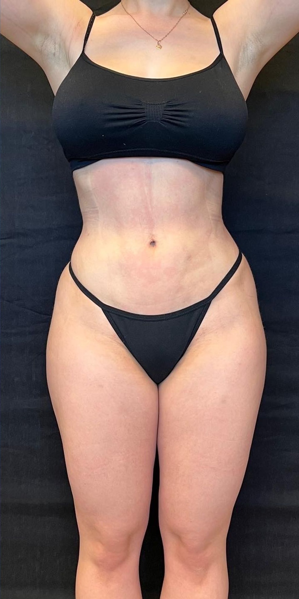 Brazilian Butt Lift Before & After Image