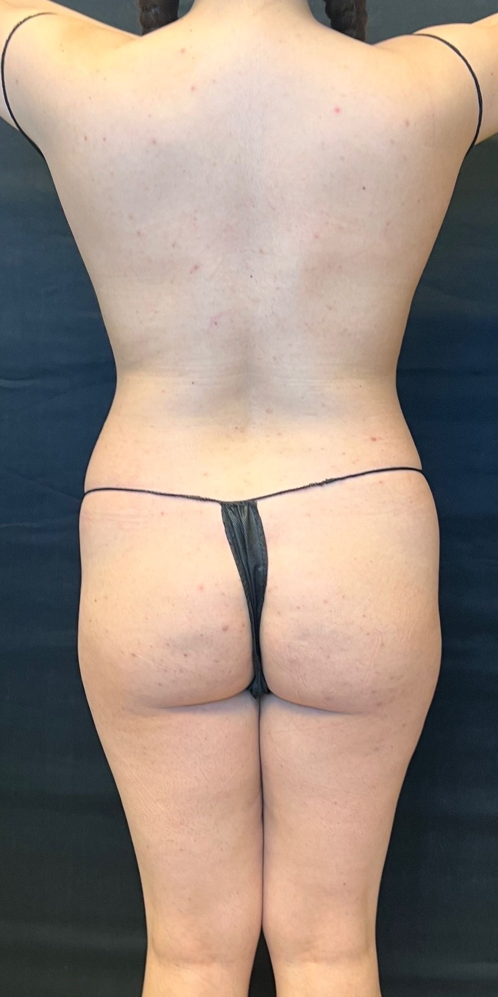 Brazilian Butt Lift Before & After Image