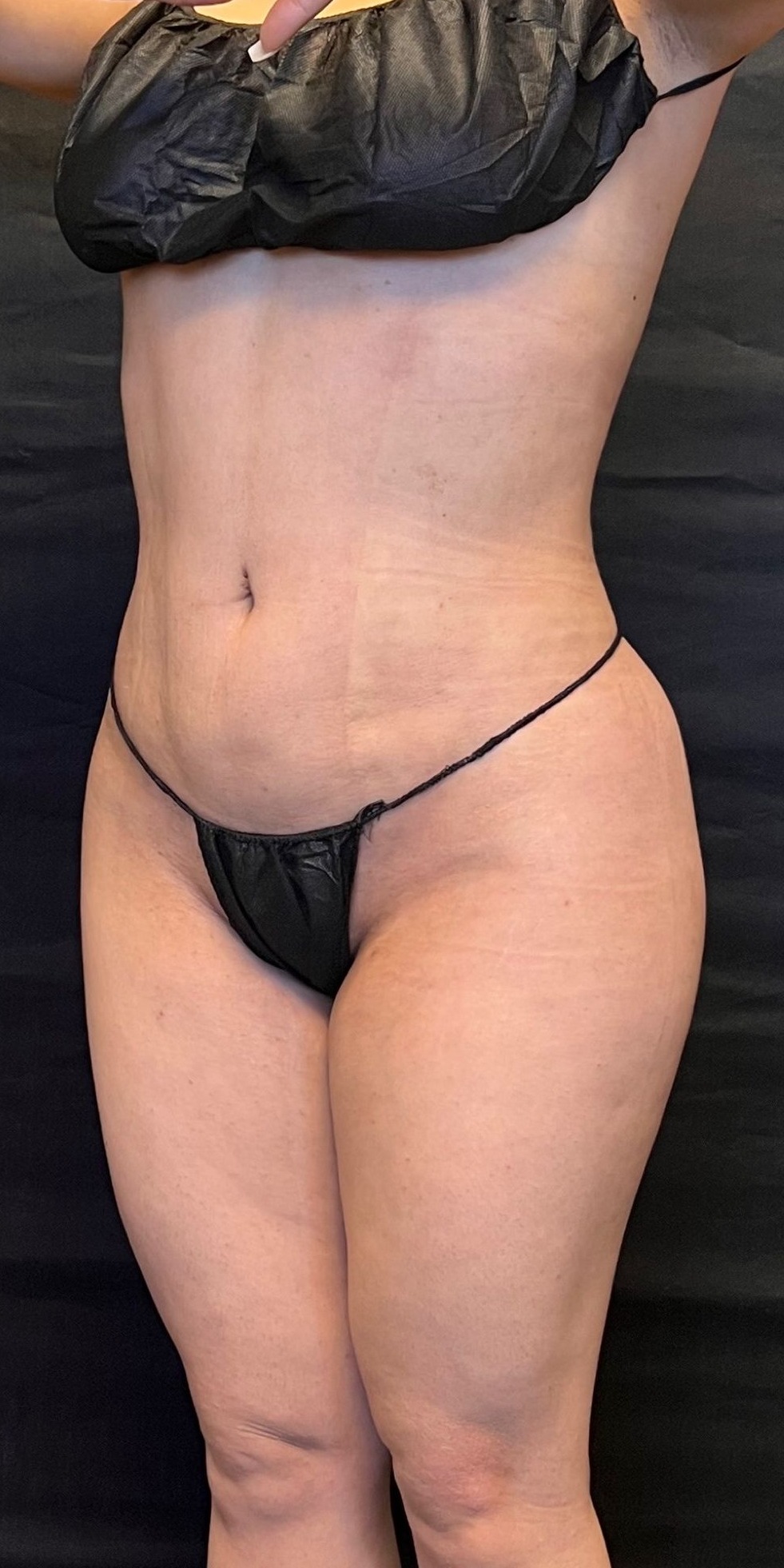 Brazilian Butt Lift Before & After Image