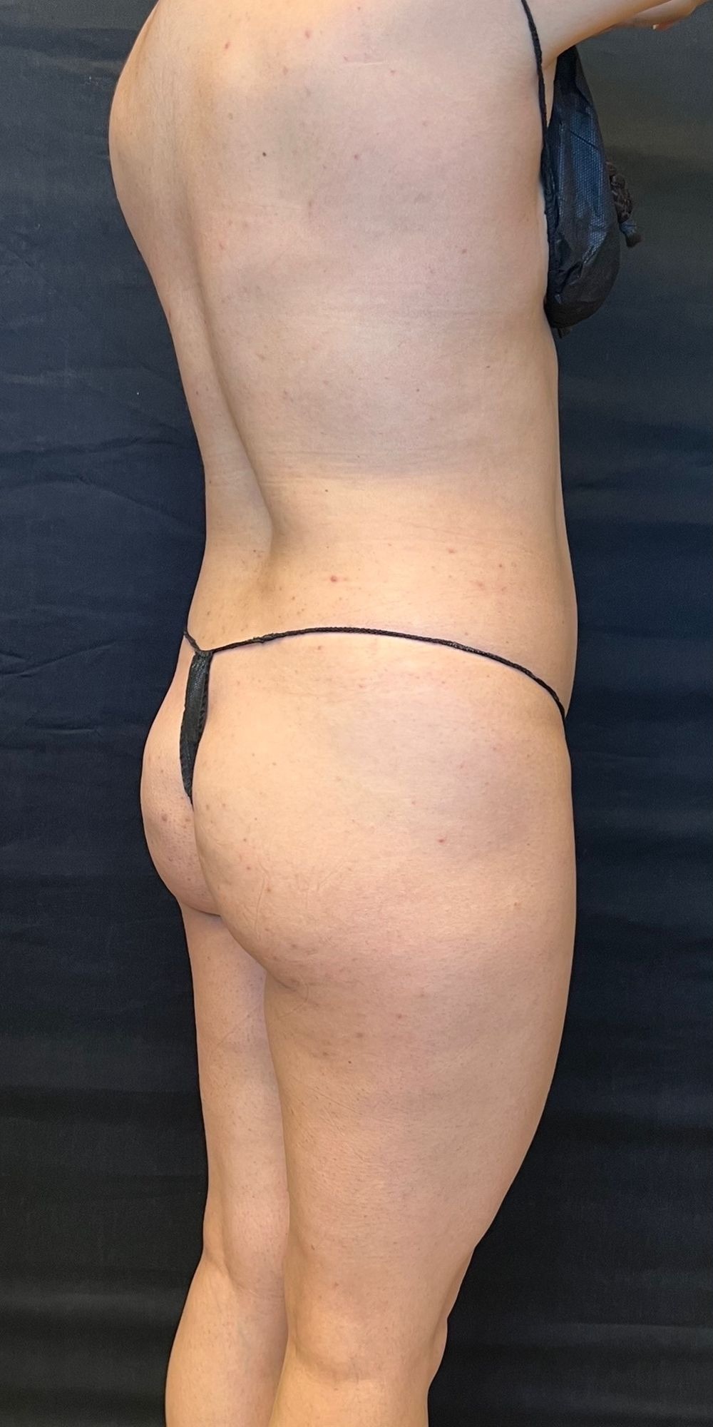 Brazilian Butt Lift Before & After Image