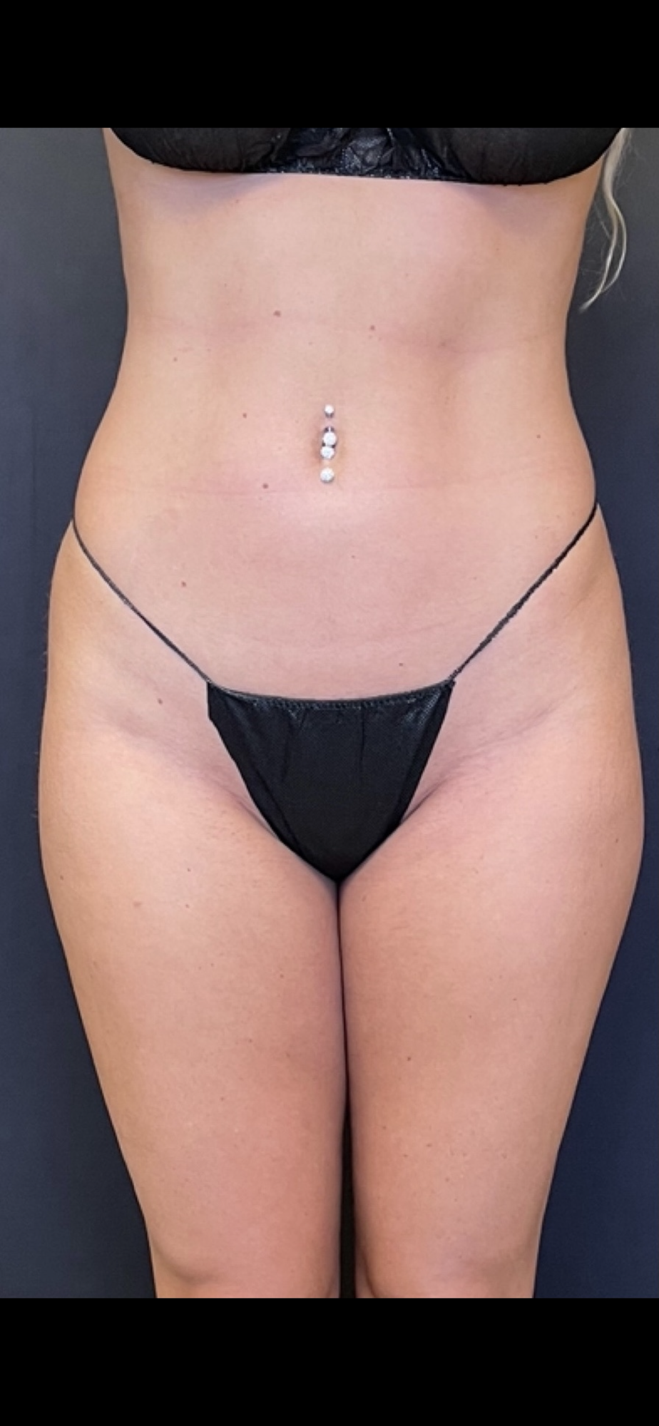 Brazilian Butt Lift Before & After Image