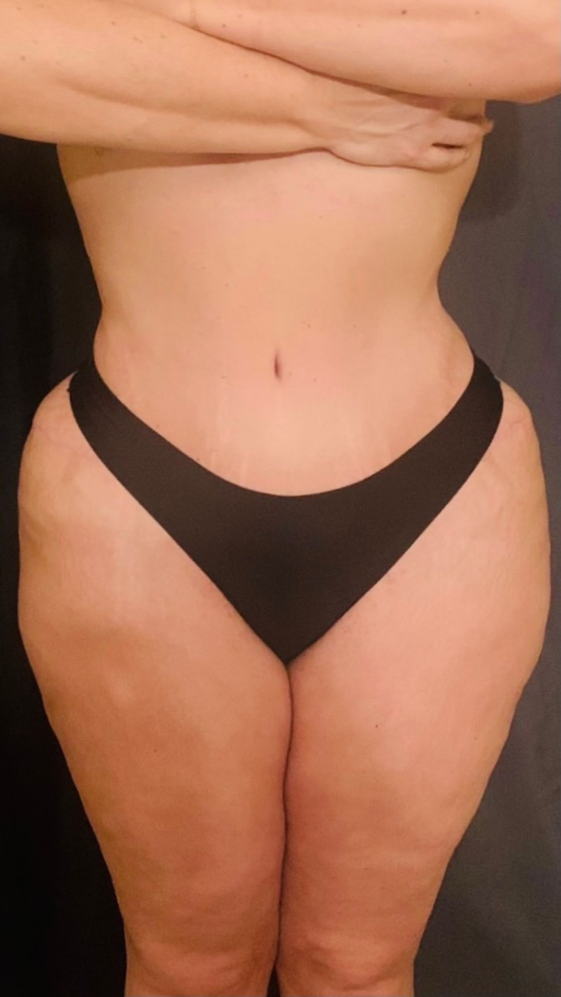 Brazilian Butt Lift Before & After Image