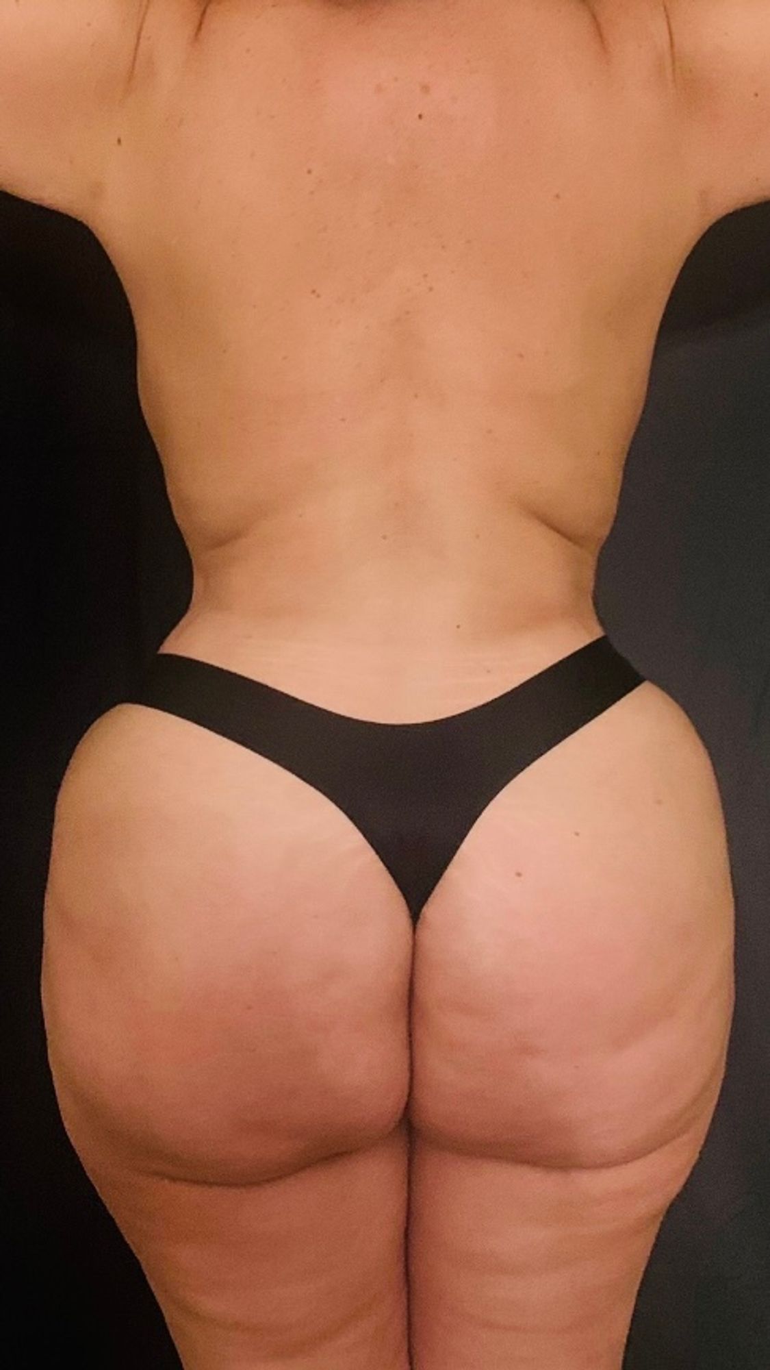 Brazilian Butt Lift Before & After Image